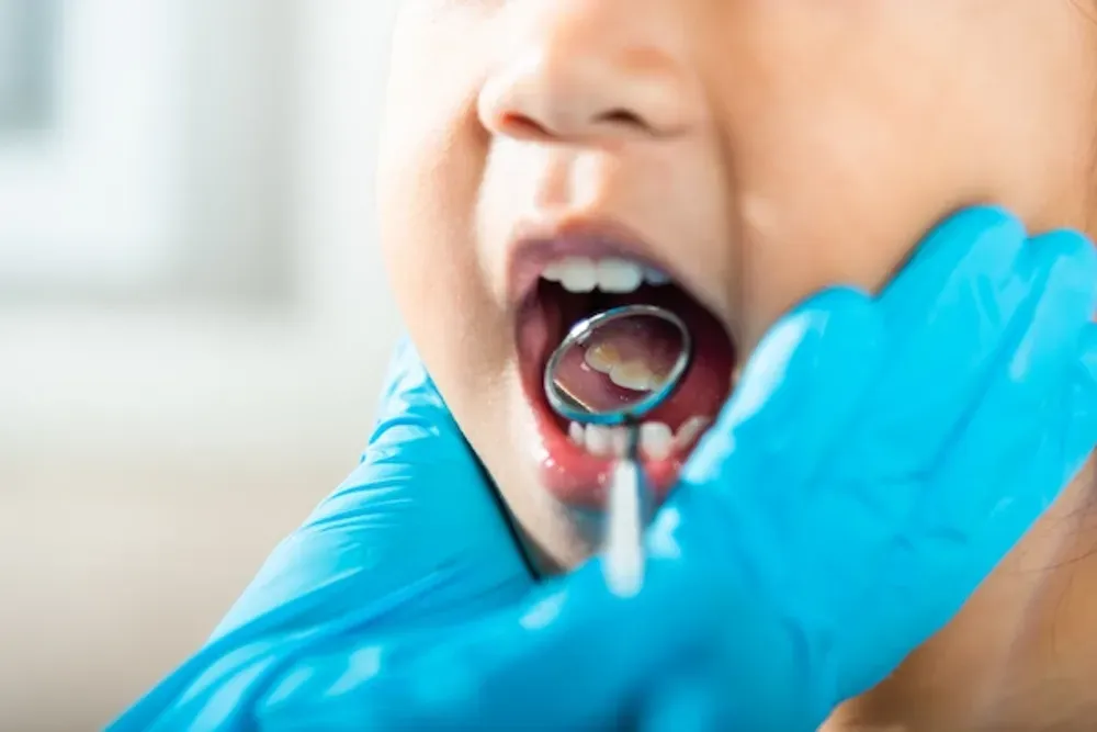 The Main Causes of Cavities in Kids